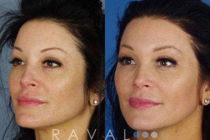 Before & After Skin Treatments Case 1090 View 3 View in Denver, CO