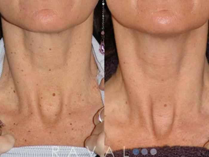 Before & After Skin Treatments Case 1092 View 1 View in Denver, CO