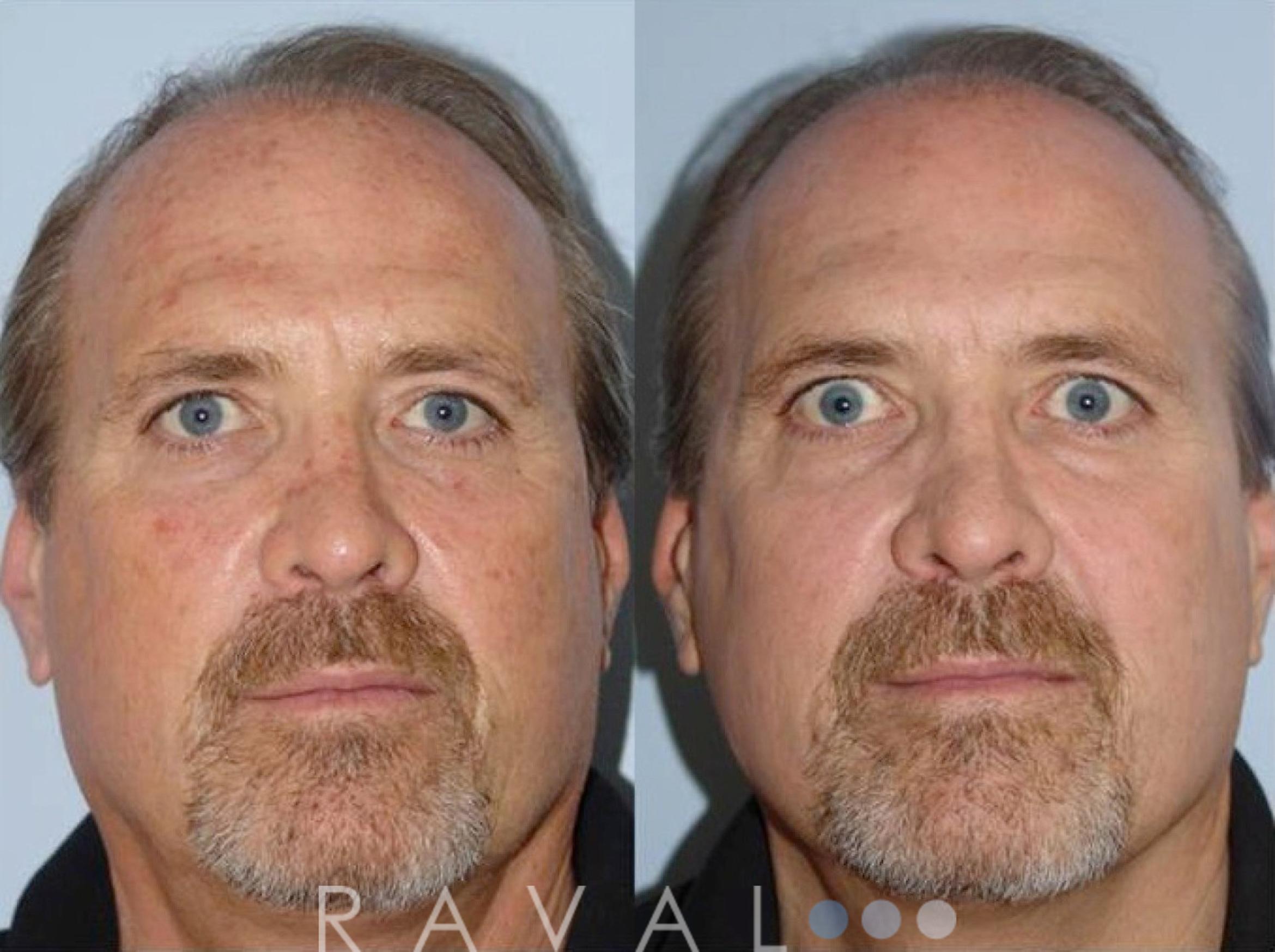 Before & After Skin Treatments Case 1093 View 1 View in Denver, CO
