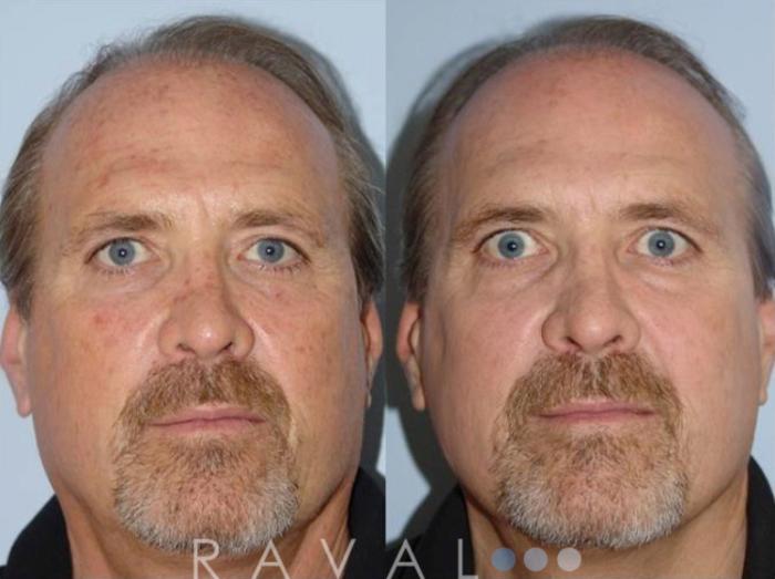 Before & After Skin Treatments Case 1093 View 1 View in Denver, CO
