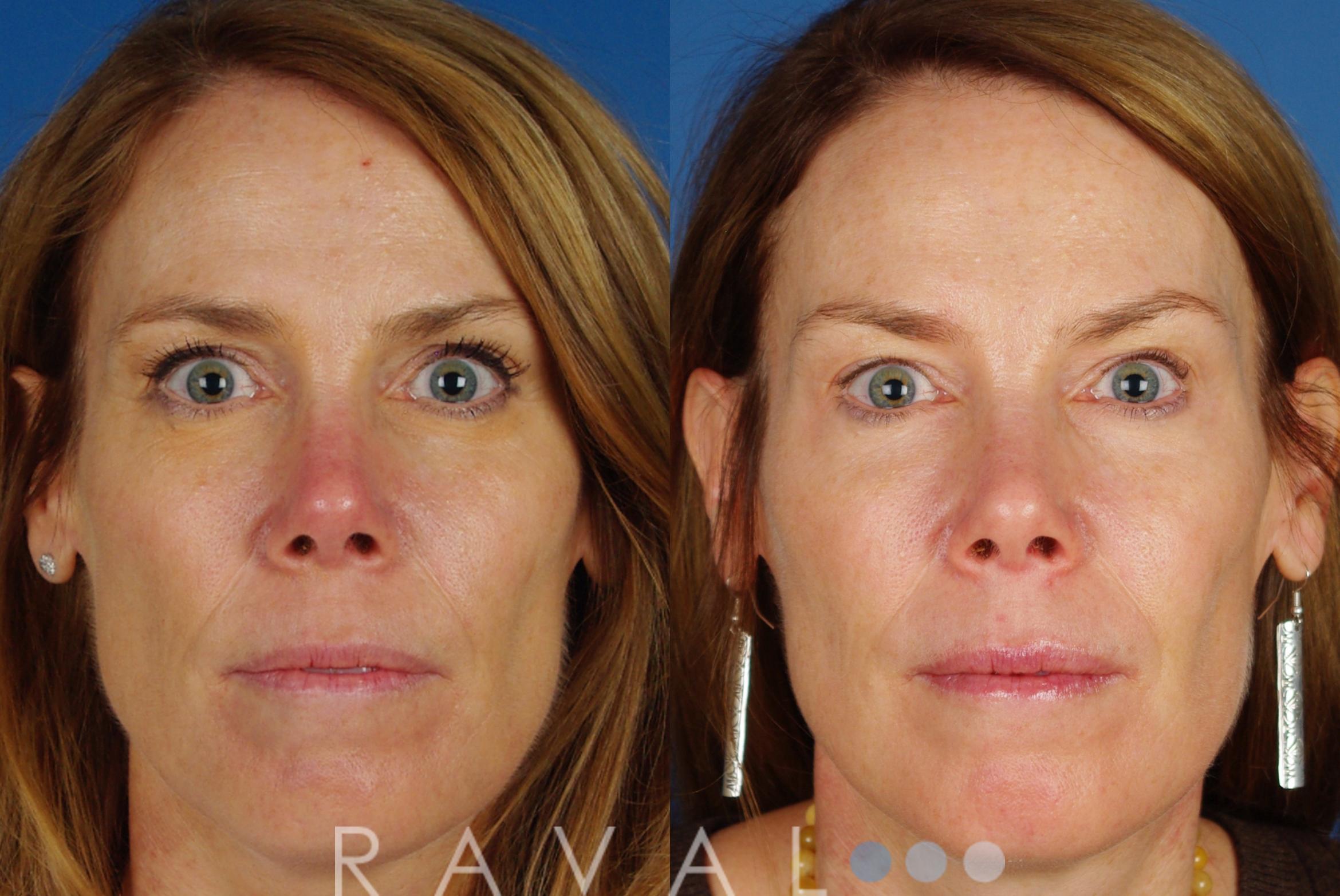 Before & After Skin Treatments Case 1094 View 1 View in Denver, CO