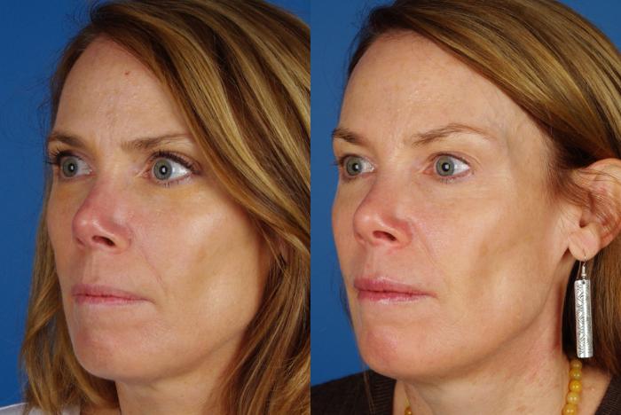 Before & After Skin Treatments Case 1094 View 2 View in Denver, CO