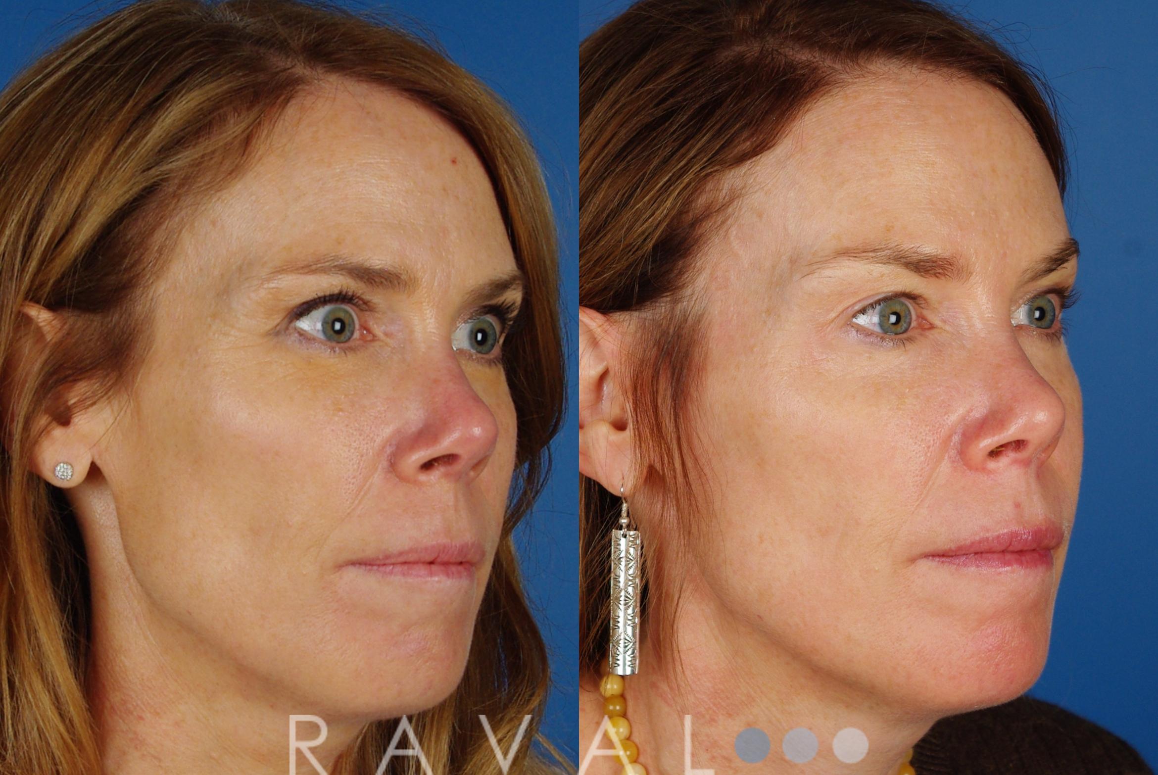 Before & After Skin Treatments Case 1094 View 3 View in Denver, CO