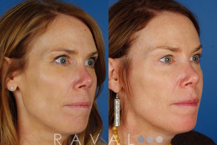 Before & After Skin Treatments Case 1094 View 3 View in Denver, CO