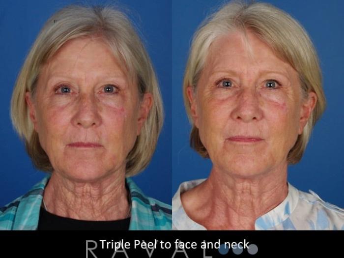Before & After Skin Treatments Case 1095 View 1 View in Denver, CO