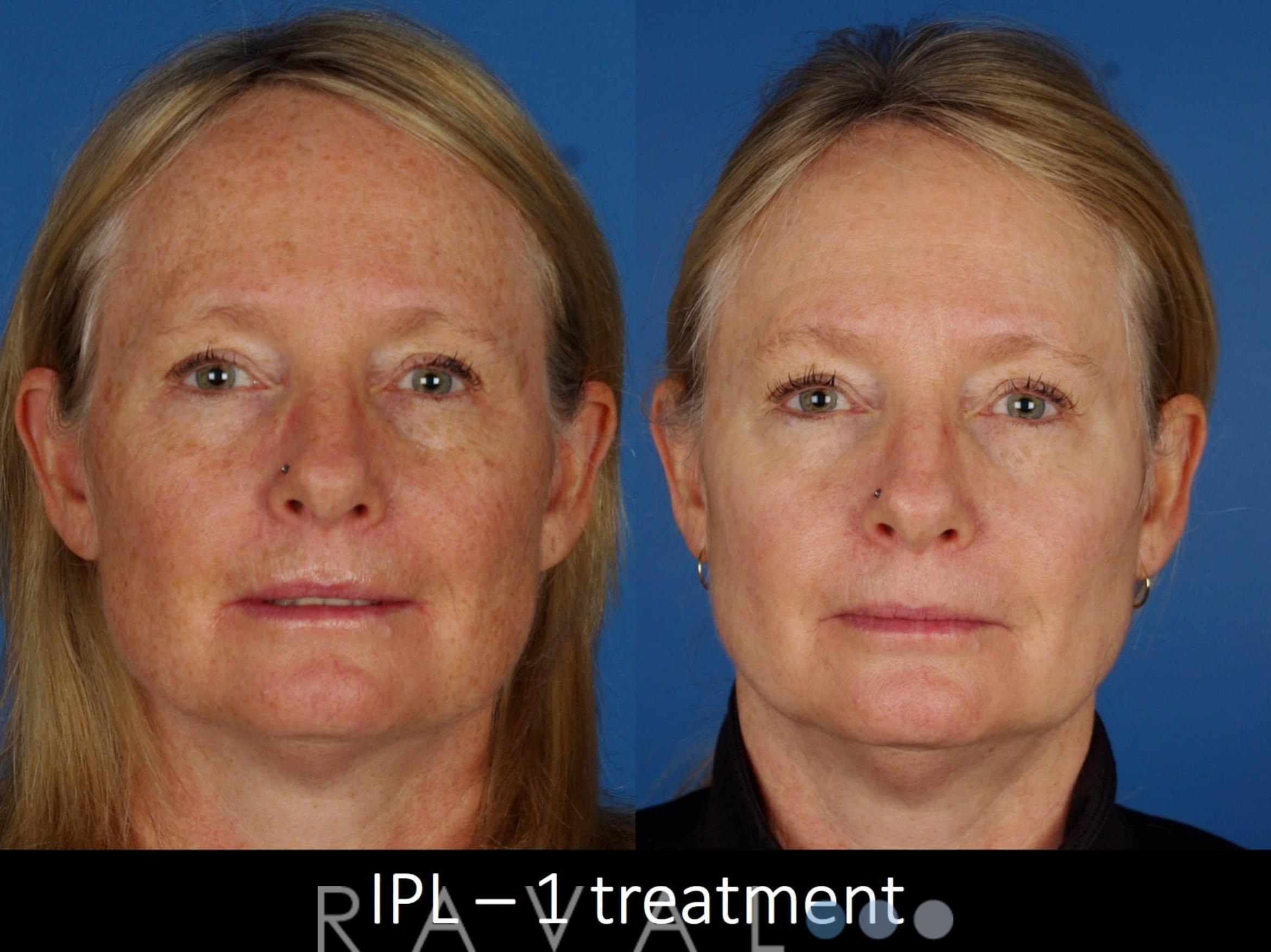 Before & After Skin Treatments Case 1096 View 1 View in Denver, CO