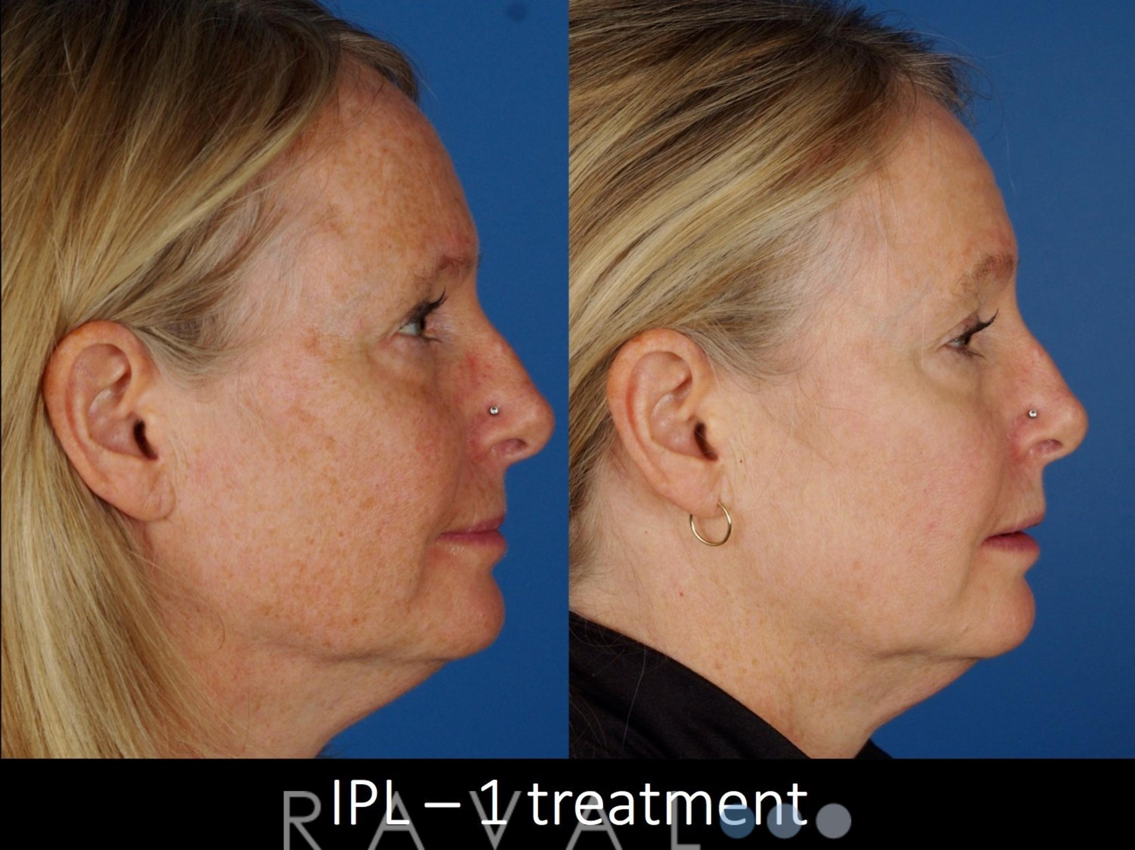 Before & After Skin Treatments Case 1096 View 2 View in Denver, CO