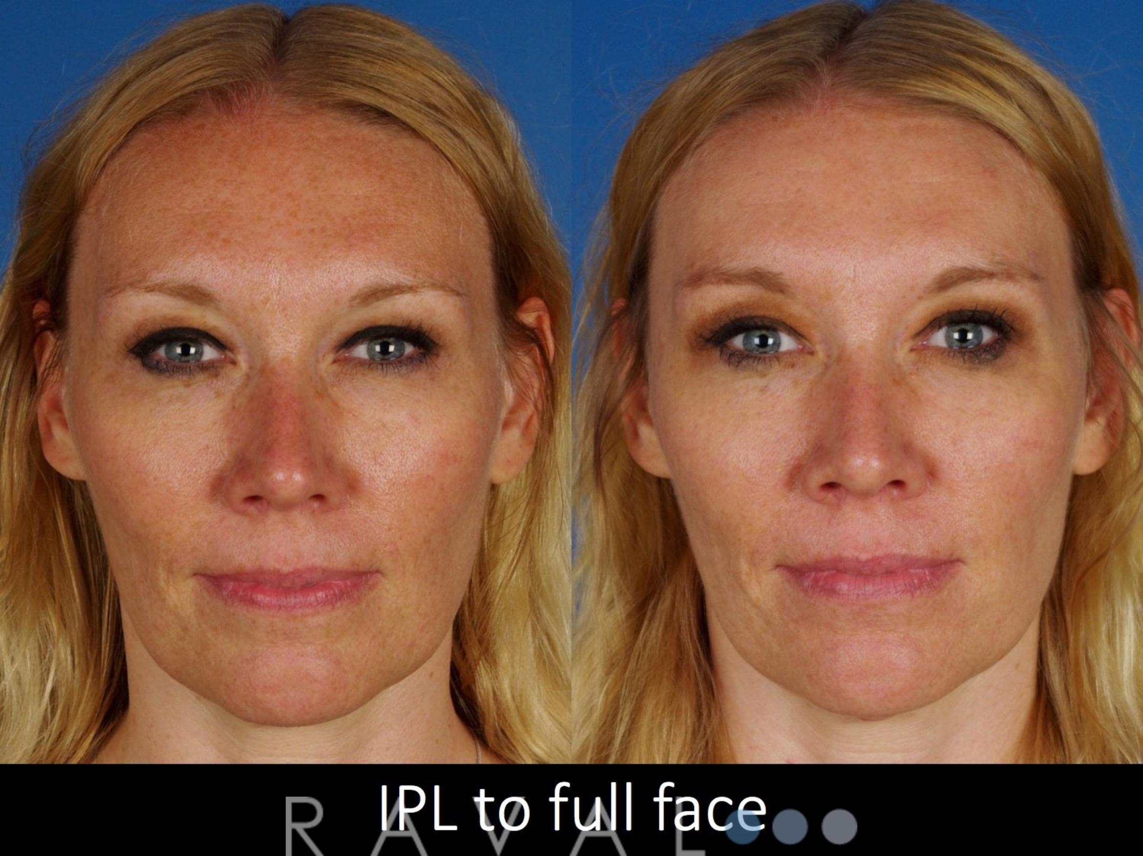 Before & After Skin Treatments Case 1097 View 1 View in Denver, CO