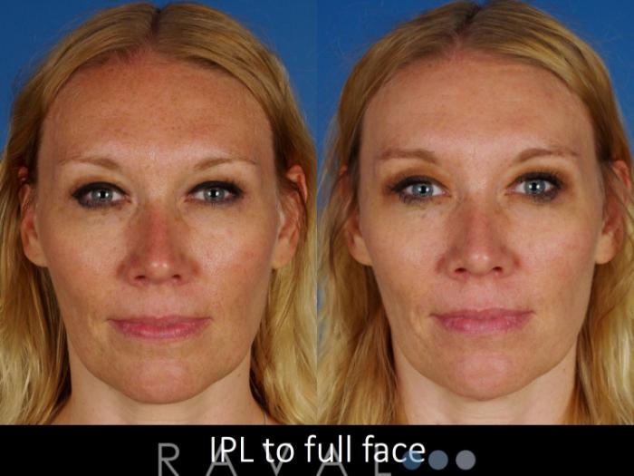 Before & After Skin Treatments Case 1097 View 1 View in Denver, CO