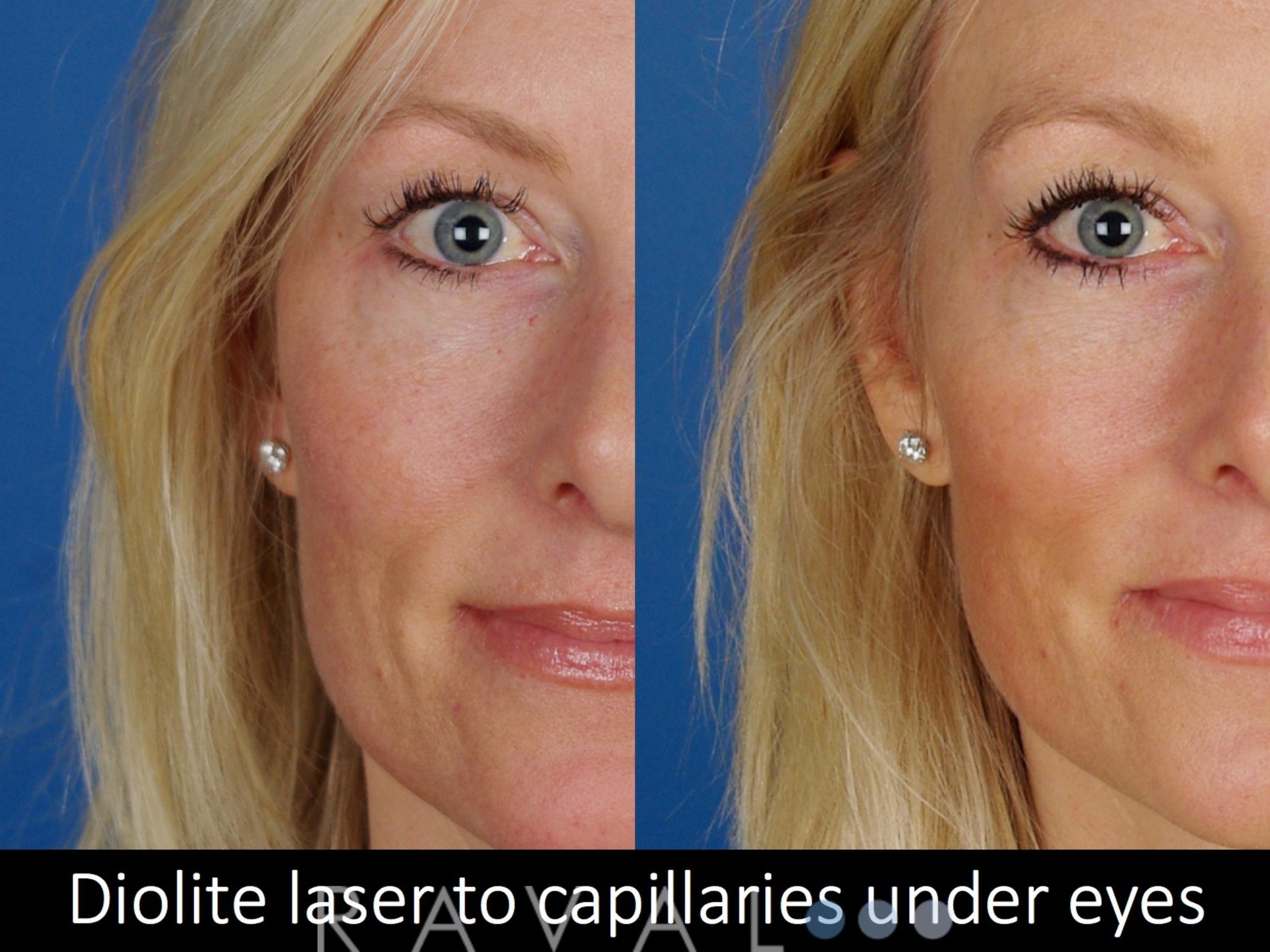 Before & After Skin Treatments Case 1098 View 1 View in Denver, CO
