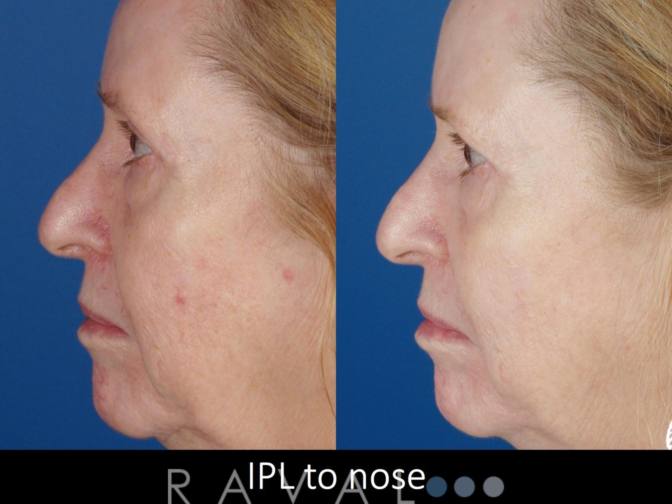 Before & After Skin Treatments Case 1099 View 1 View in Denver, CO