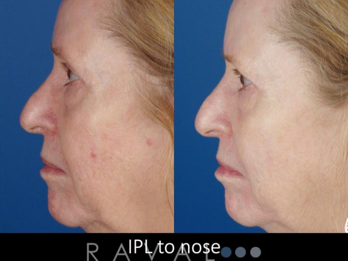 Before & After Skin Treatments Case 1099 View 1 View in Denver, CO