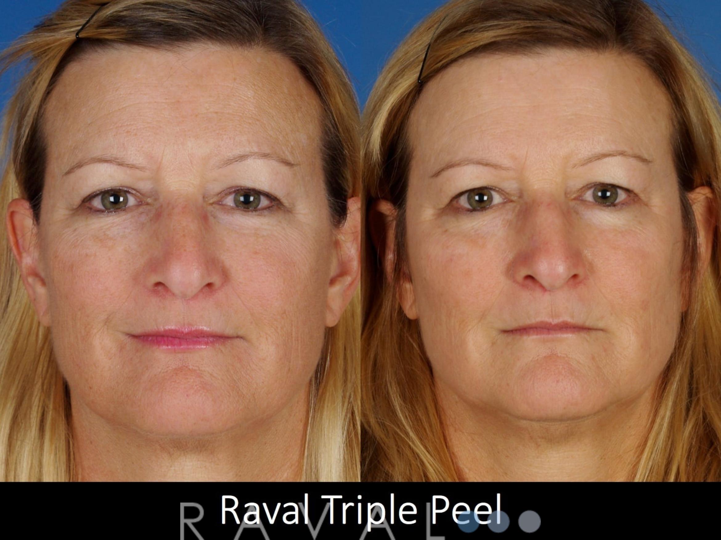 Before & After Skin Treatments Case 1100 View 1 View in Denver, CO