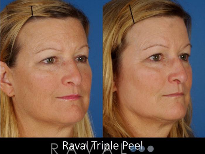 Before & After Skin Treatments Case 1100 View 2 View in Denver, CO