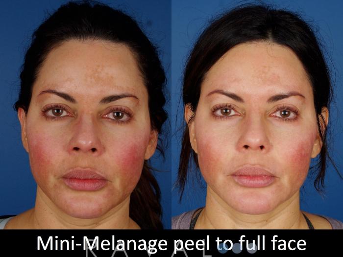 Before & After Skin Treatments Case 1101 View 1 View in Denver, CO