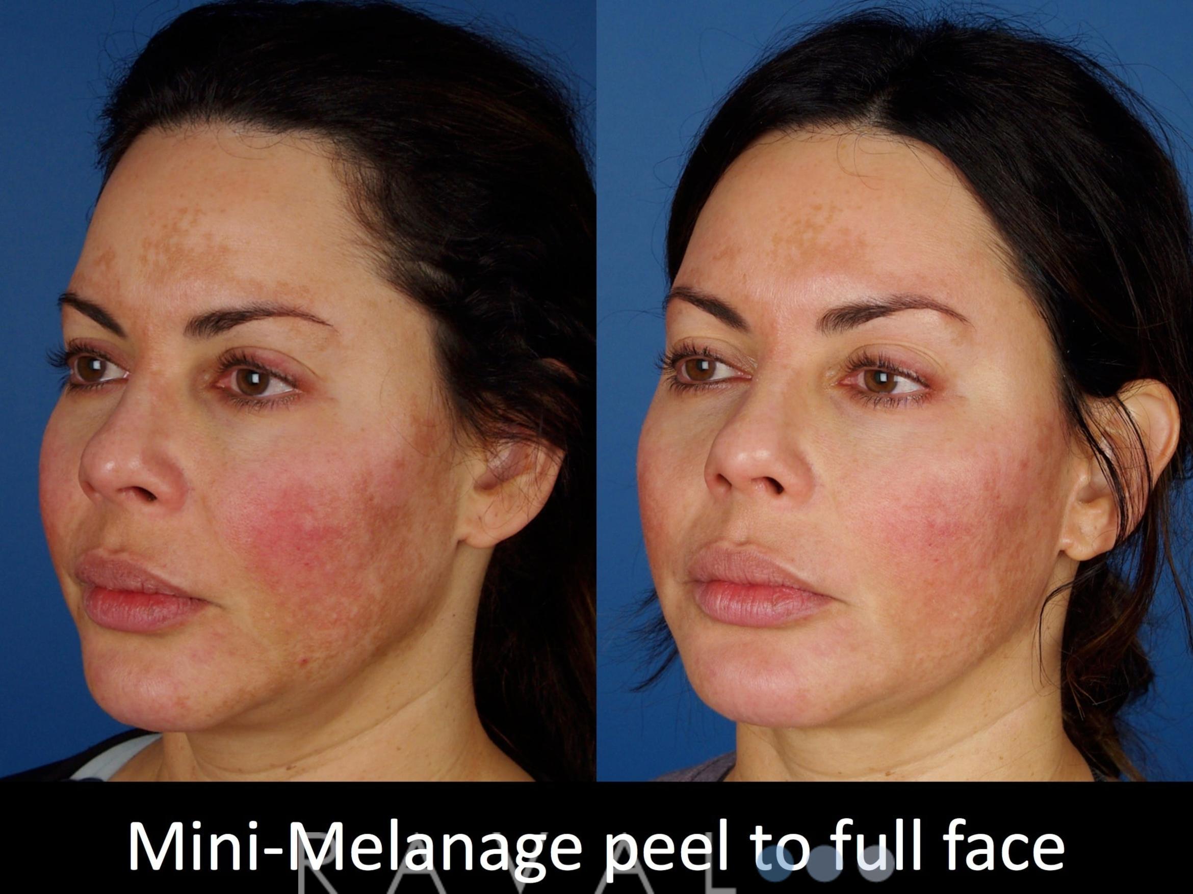 Before & After Skin Treatments Case 1101 View 2 View in Denver, CO