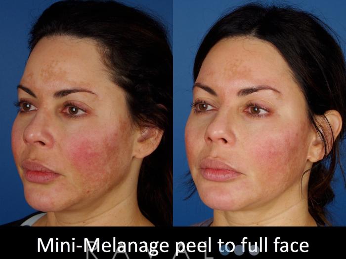 Before & After Skin Treatments Case 1101 View 2 View in Denver, CO
