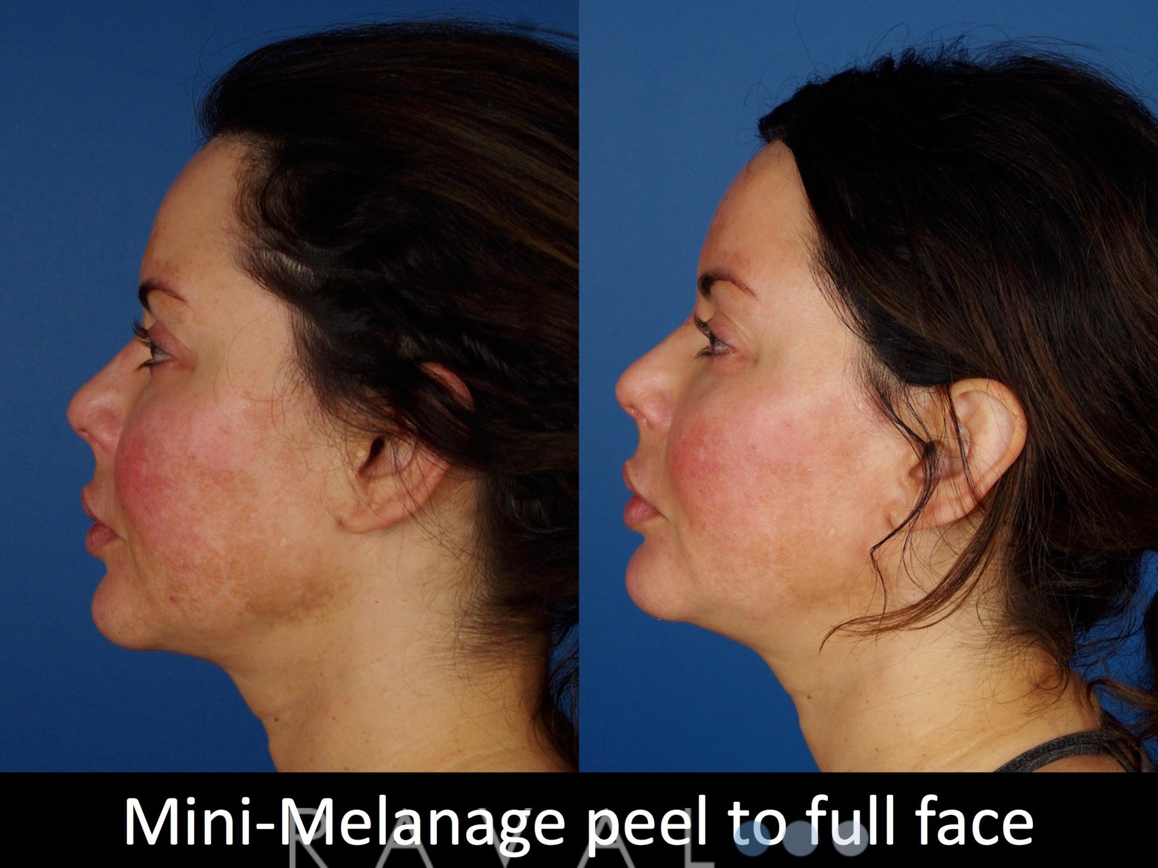 Before & After Skin Treatments Case 1101 View 3 View in Denver, CO