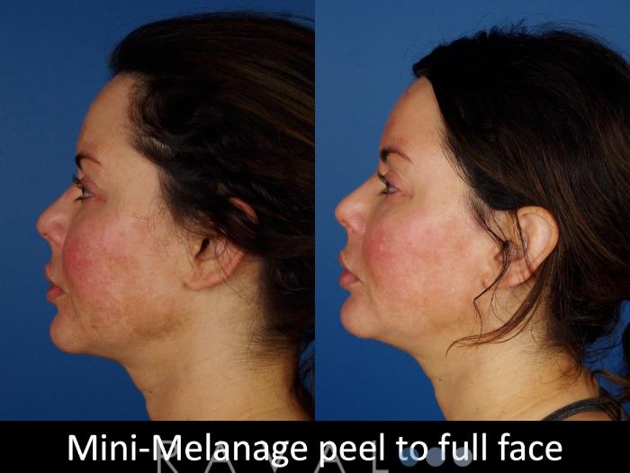 Before & After Skin Treatments Case 1101 View 3 View in Denver, CO