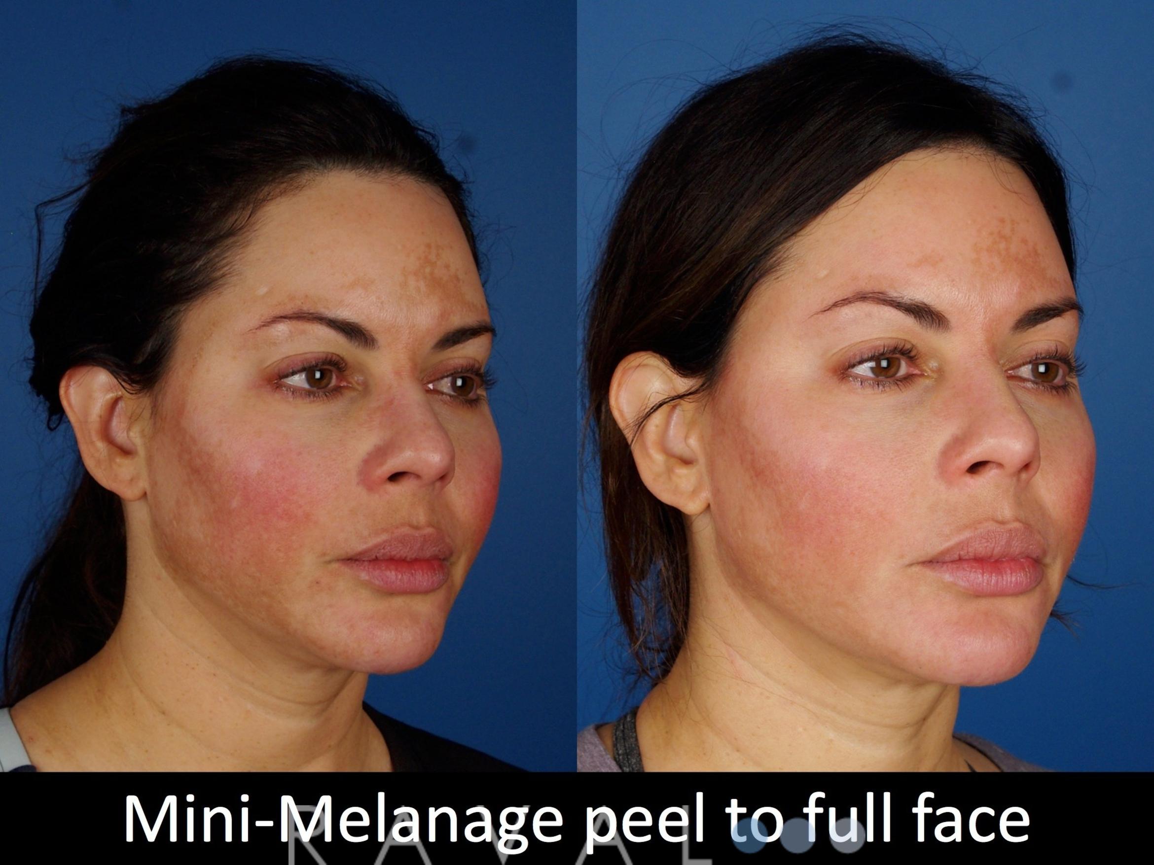 Before & After Skin Treatments Case 1101 View 4 View in Denver, CO