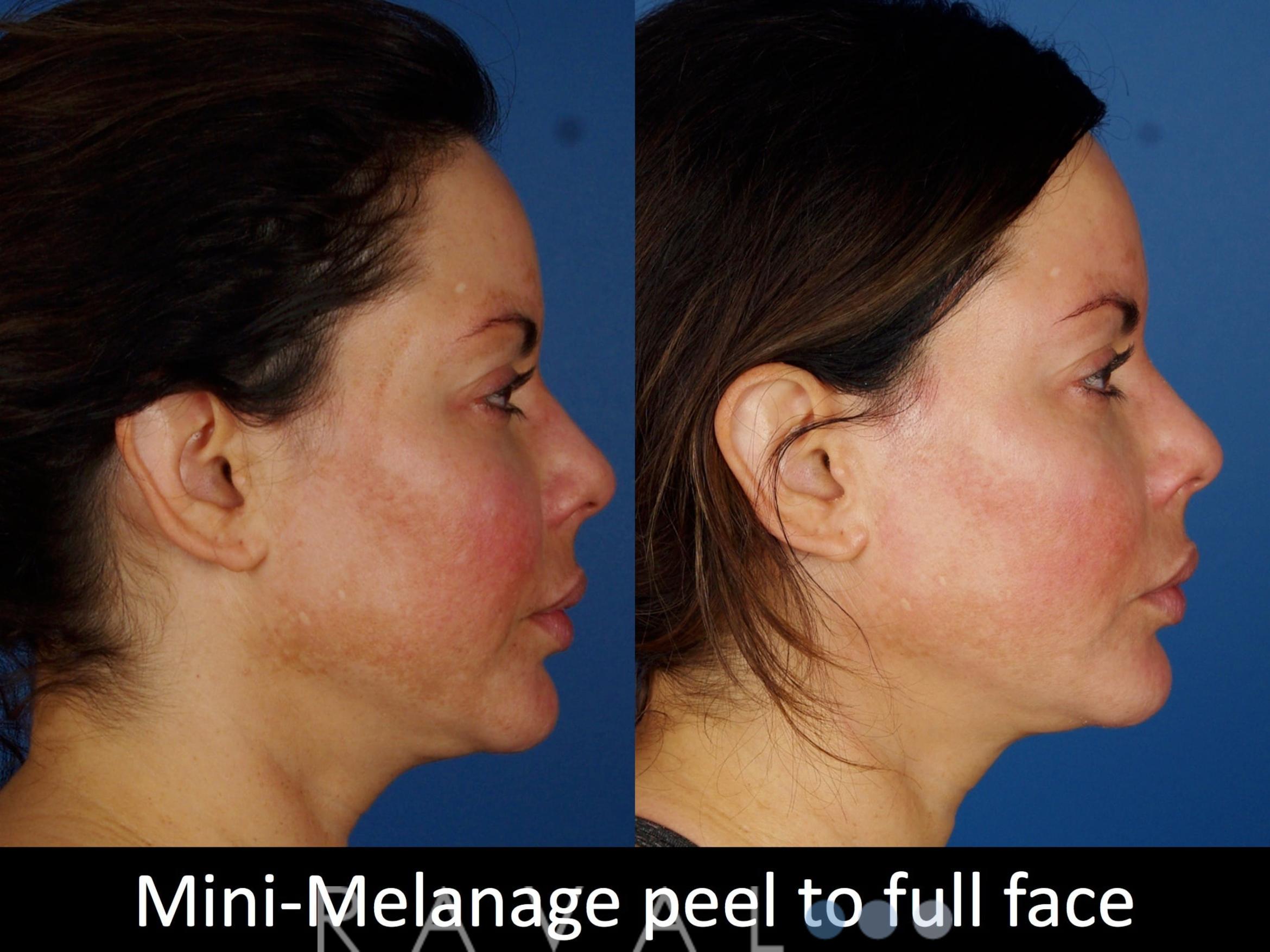 Before & After Skin Treatments Case 1101 View 5 View in Denver, CO