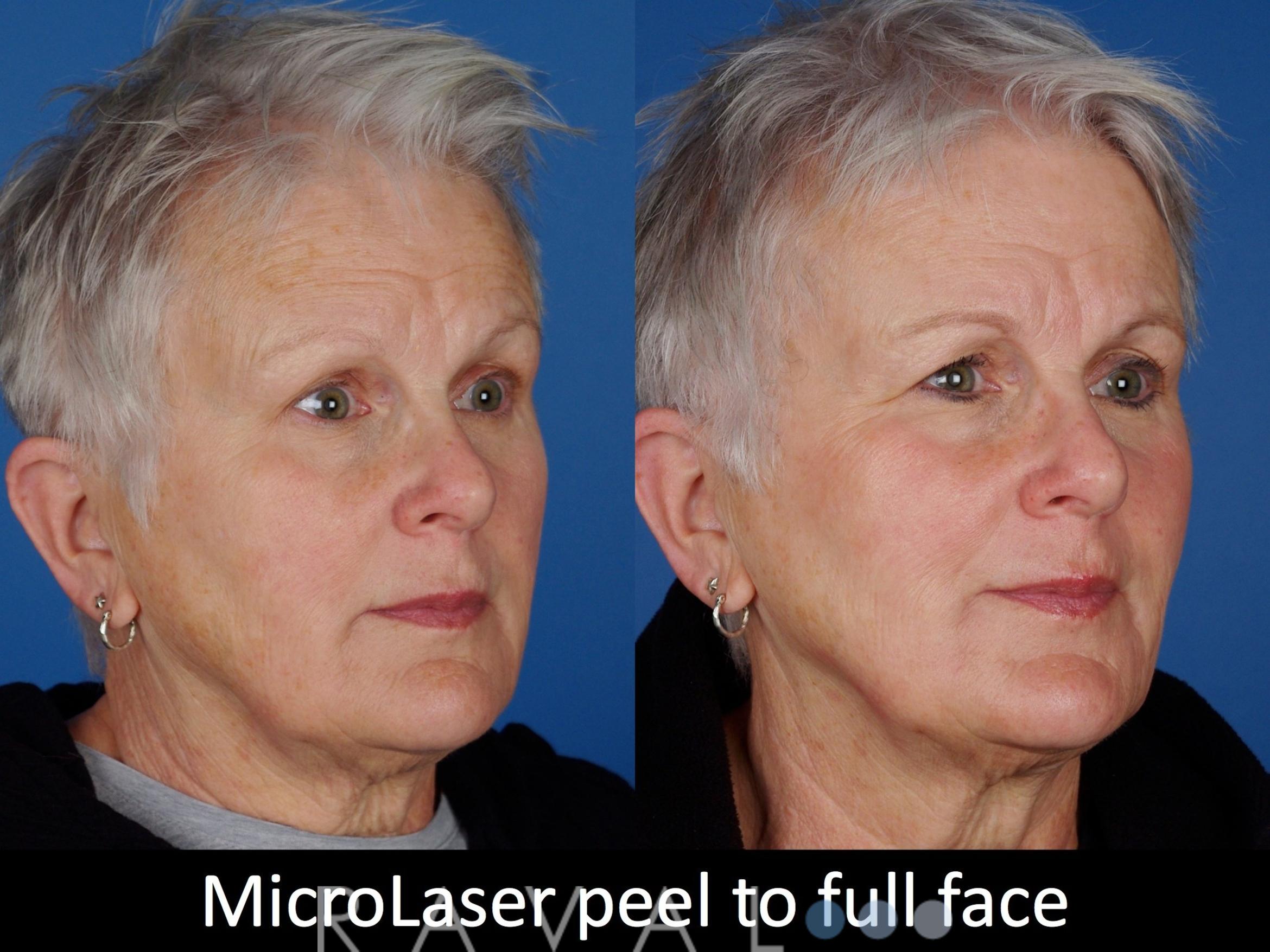 Before & After Skin Treatments Case 1102 View 1 View in Denver, CO