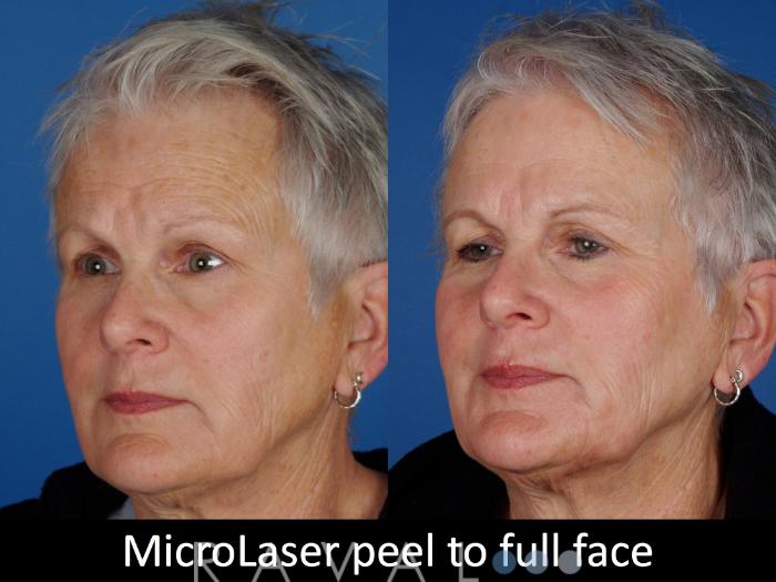 Before & After Skin Treatments Case 1102 View 2 View in Denver, CO