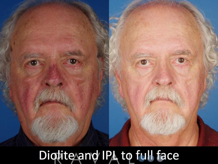 Before & After Skin Treatments Case 1103 View 1 View in Denver, CO