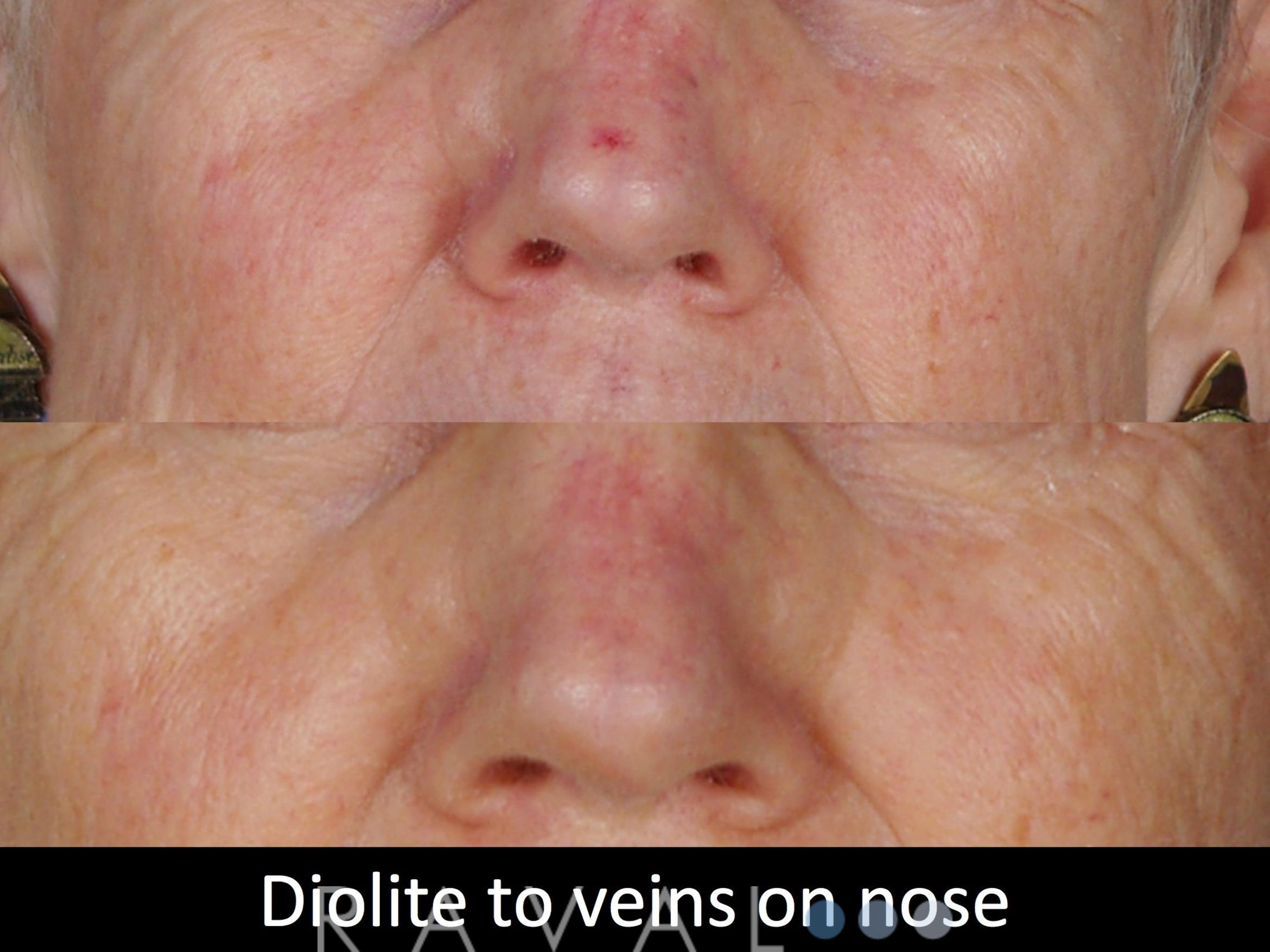 Before & After Skin Treatments Case 1104 View 1 View in Denver, CO