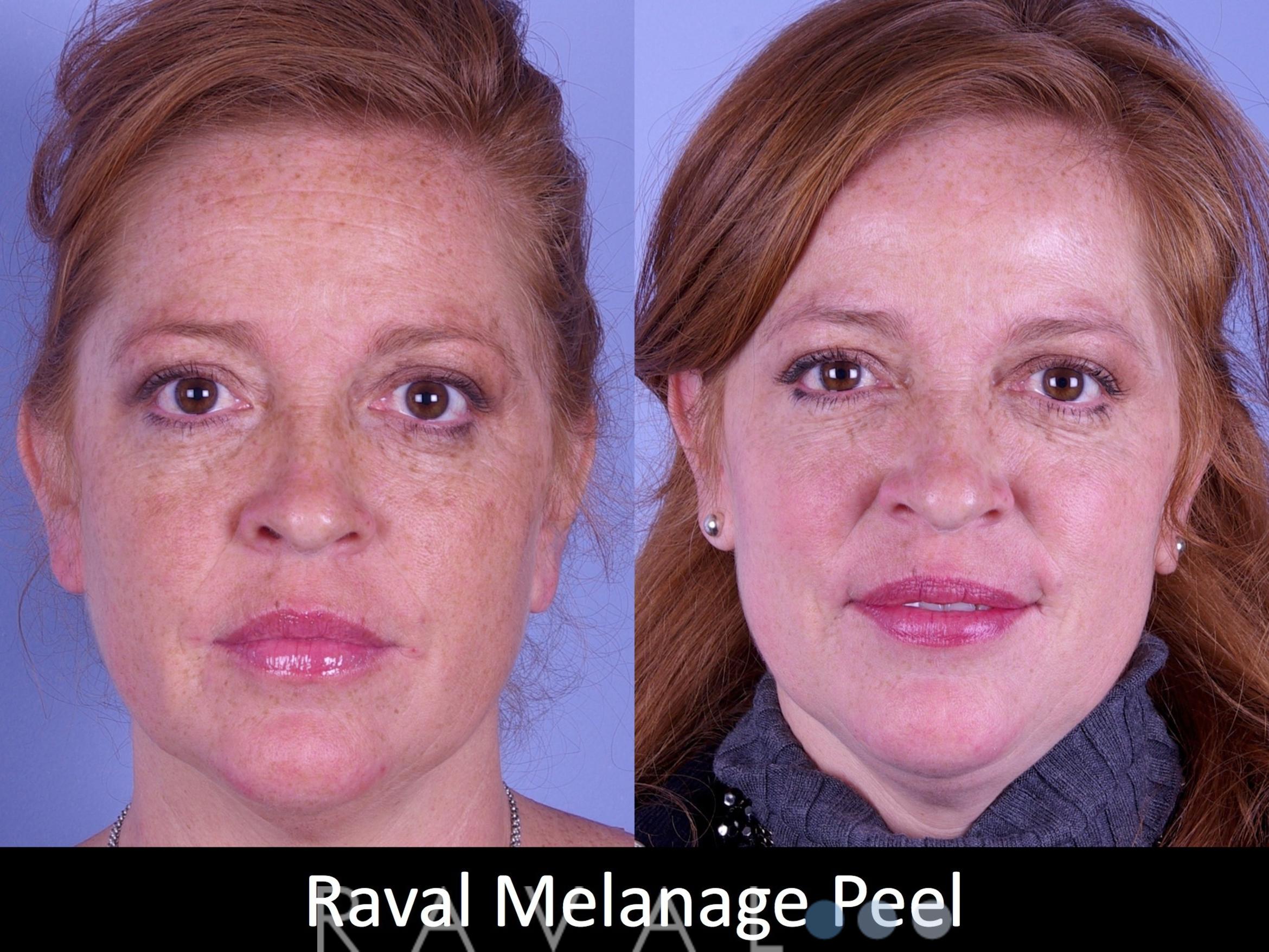 Before & After Skin Treatments Case 1105 View 1 View in Denver, CO
