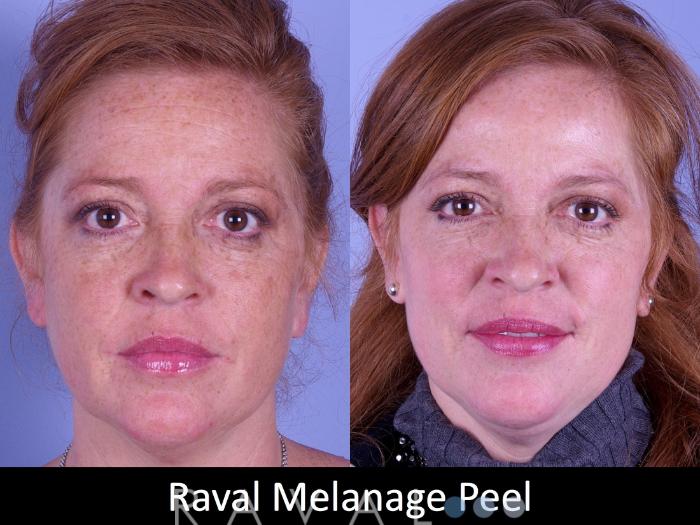 Before & After Skin Treatments Case 1105 View 1 View in Denver, CO