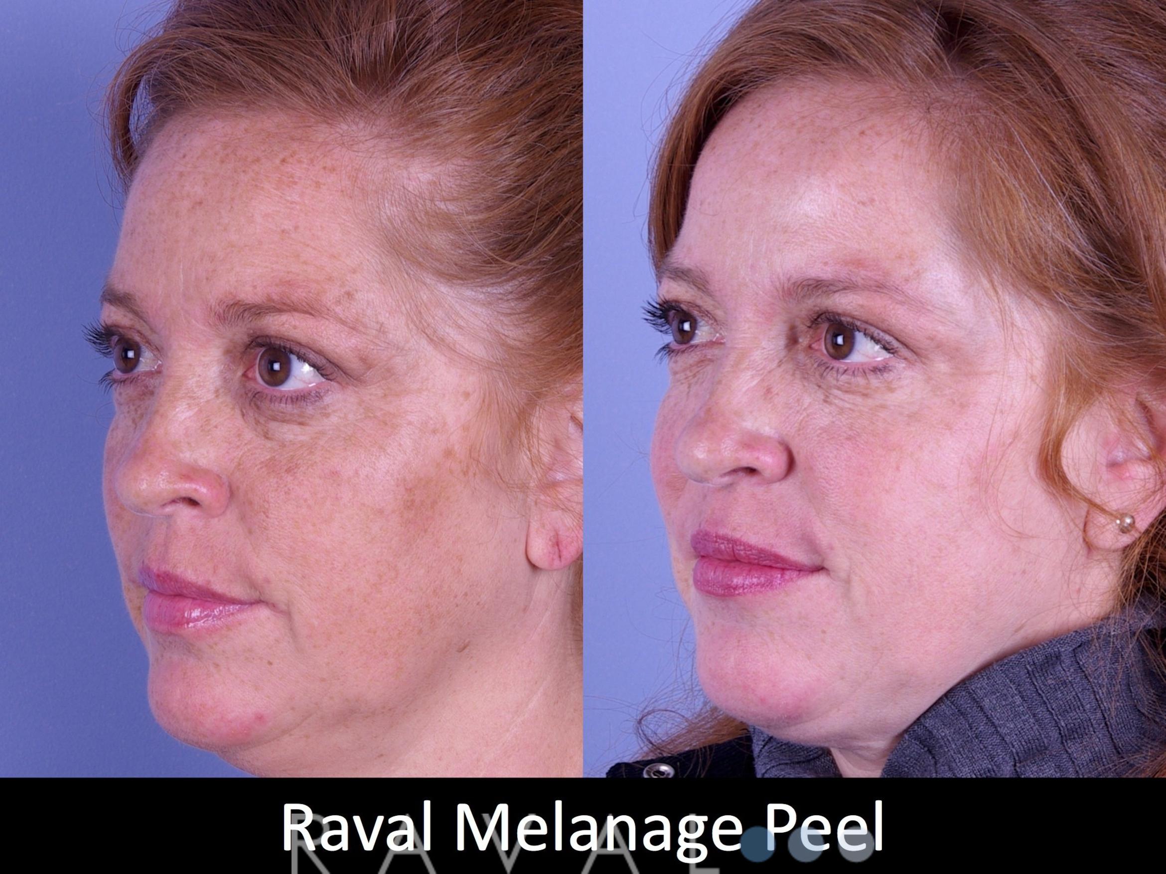 Before & After Skin Treatments Case 1105 View 2 View in Denver, CO