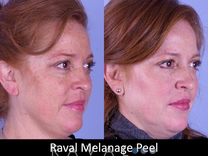 Before & After Skin Treatments Case 1105 View 3 View in Denver, CO