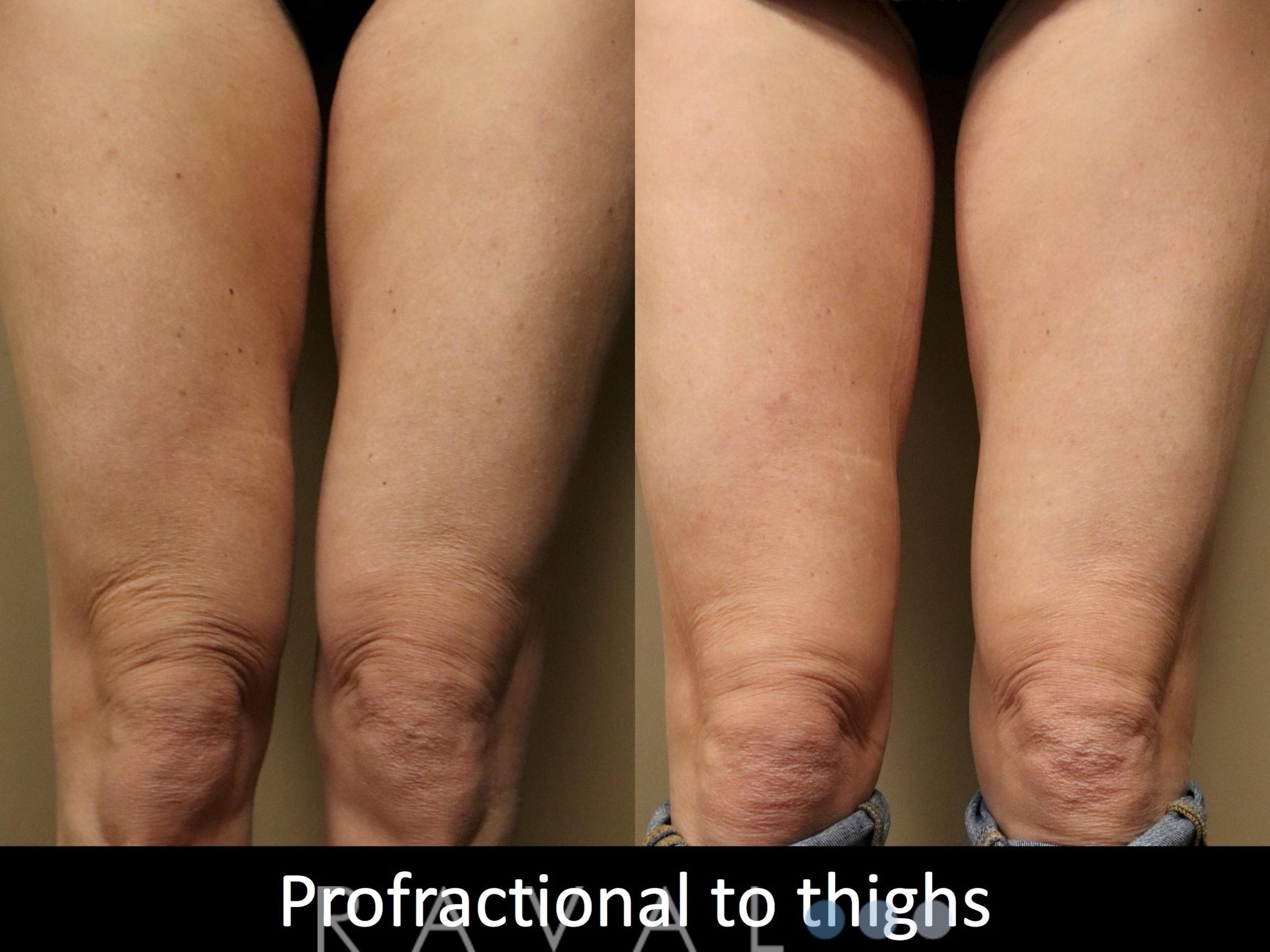 Before & After Skin Treatments Case 1106 View 1 View in Denver, CO