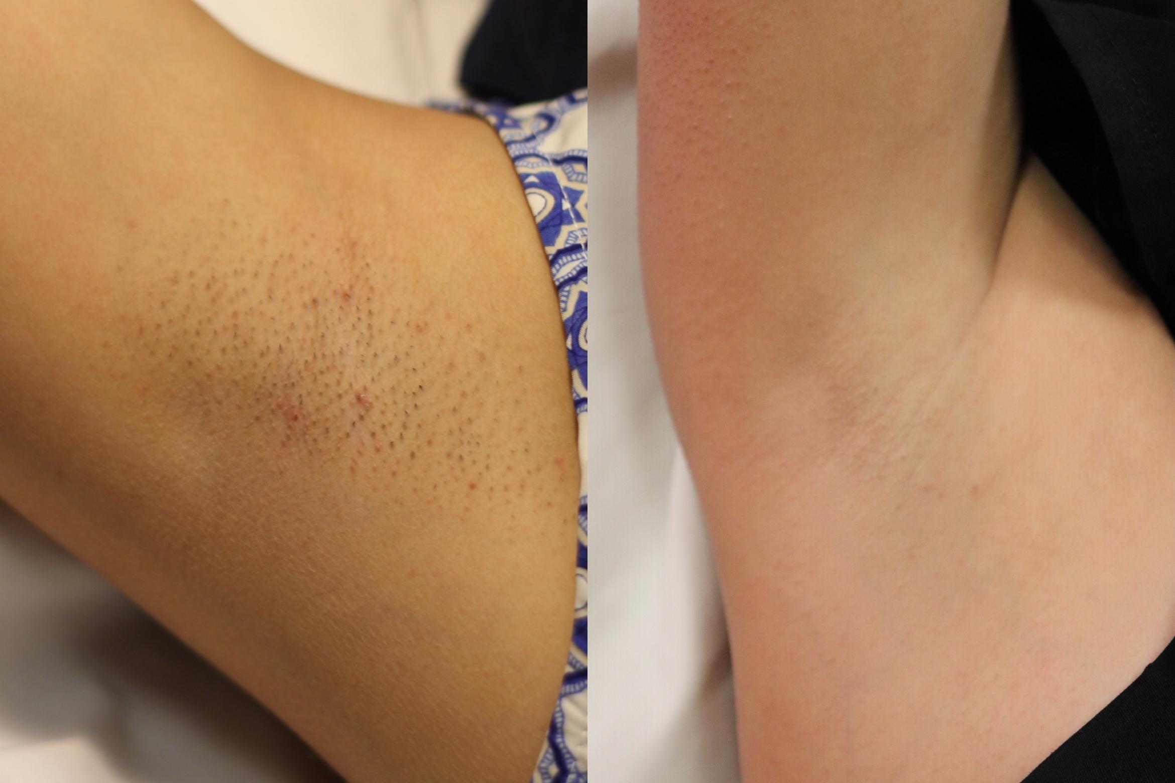 Before & After Skin Treatments Case 1107 View 1 View in Denver, CO