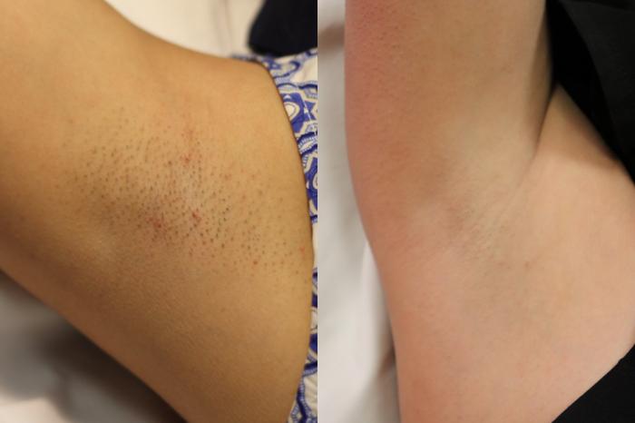 Before & After Skin Treatments Case 1107 View 1 View in Denver, CO