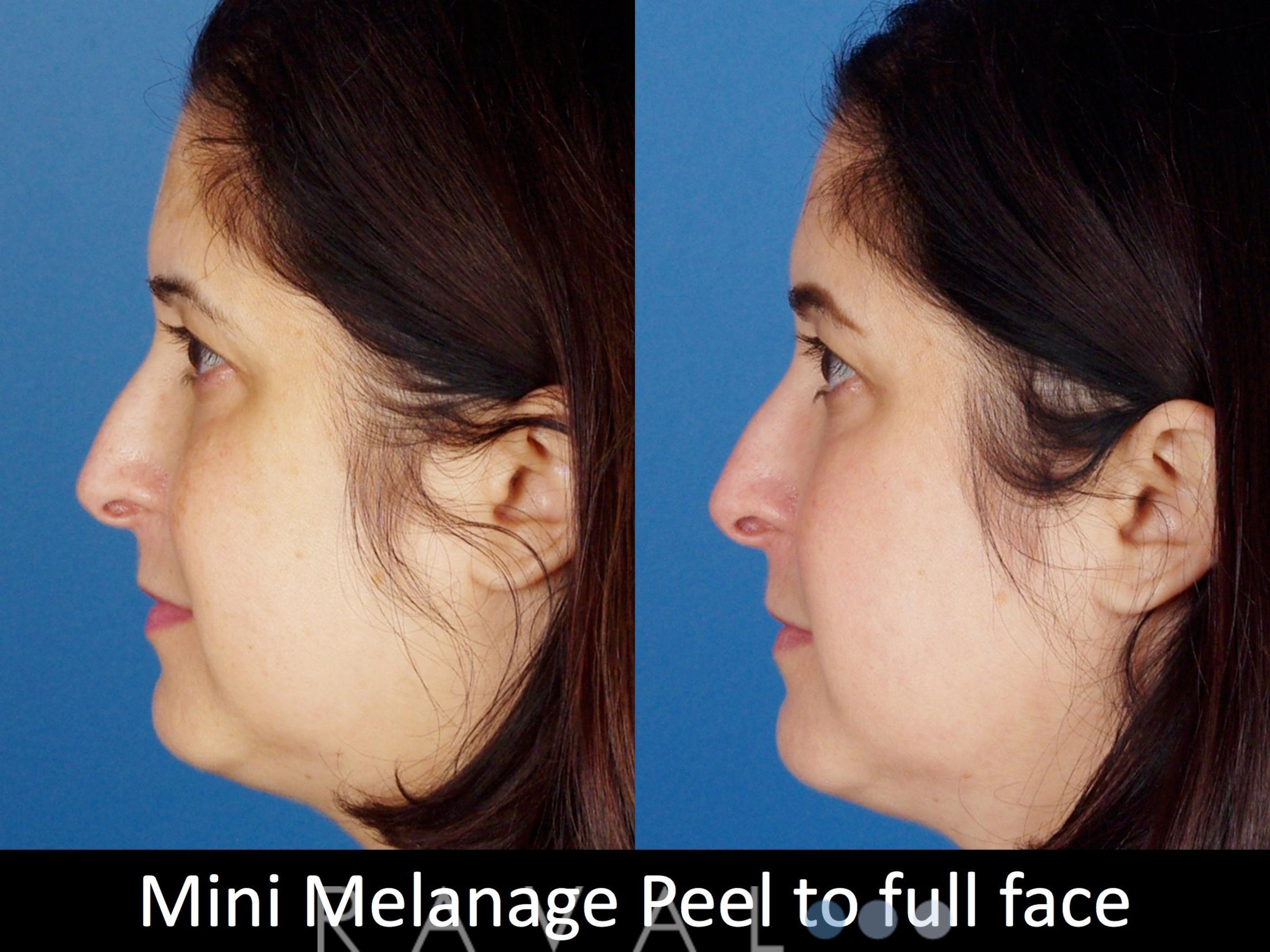 Before & After Skin Treatments Case 1108 View 1 View in Denver, CO