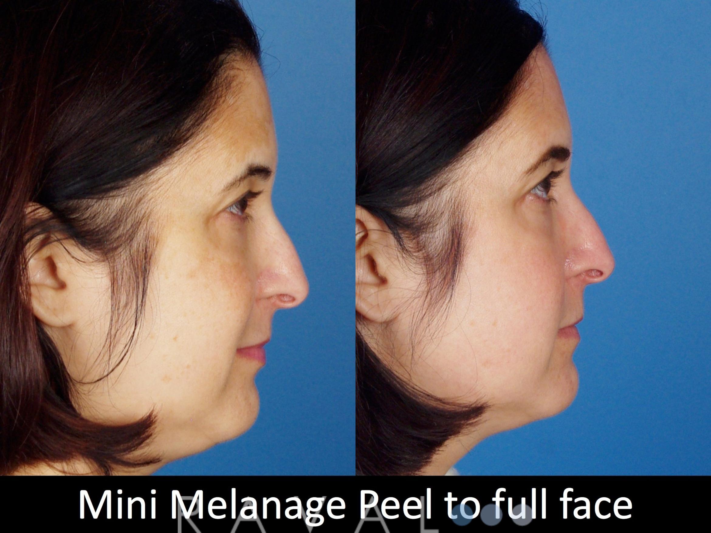 Before & After Skin Treatments Case 1108 View 2 View in Denver, CO