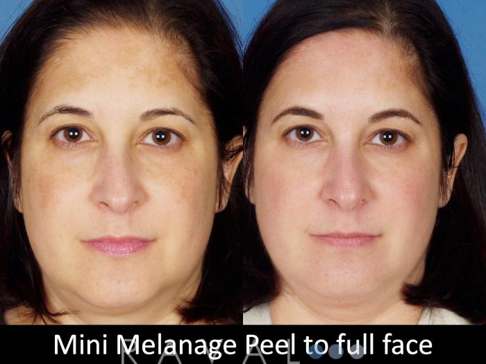 Before & After Skin Treatments Case 1108 View 3 View in Denver, CO