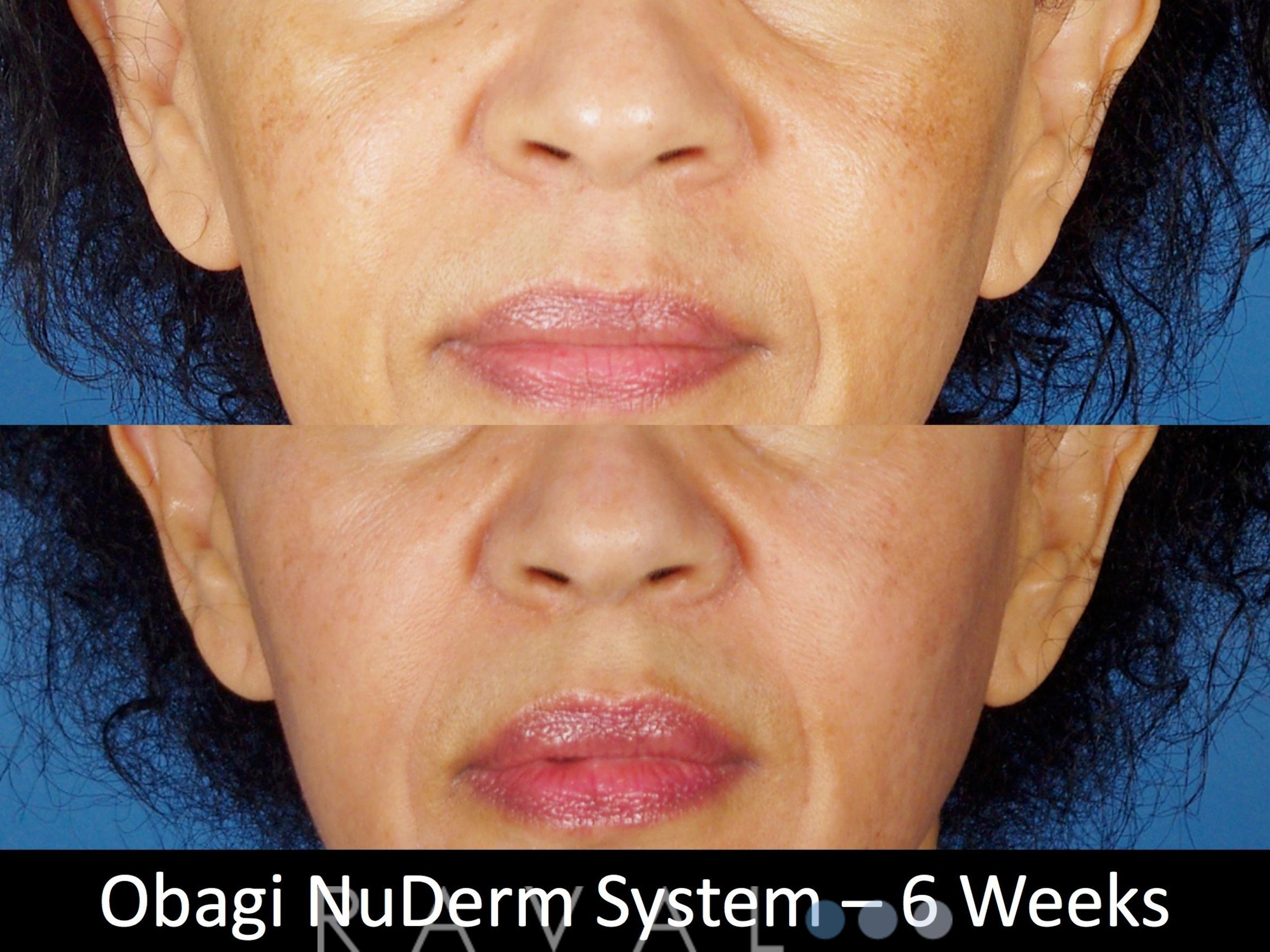 Before & After Skin Treatments Case 1109 View 1 View in Denver, CO