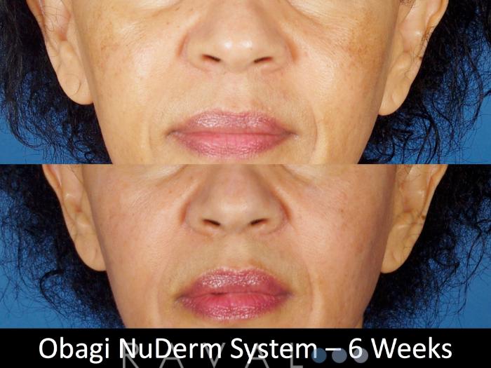 Before & After Skin Treatments Case 1109 View 1 View in Denver, CO