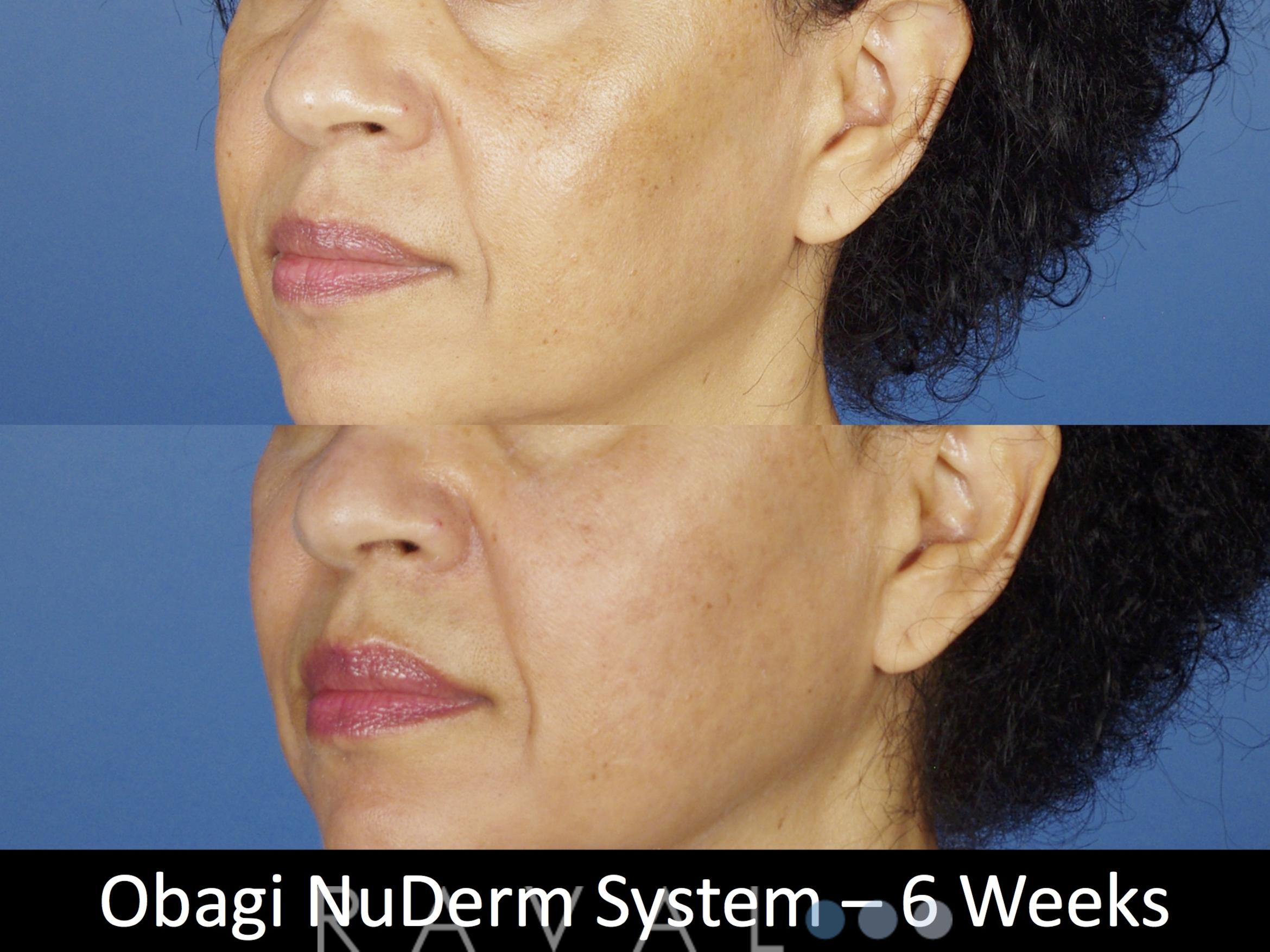 Before & After Skin Treatments Case 1109 View 2 View in Denver, CO
