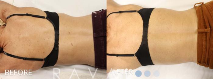 Before & After Skin Treatments Case 1110 View 1 View in Denver, CO