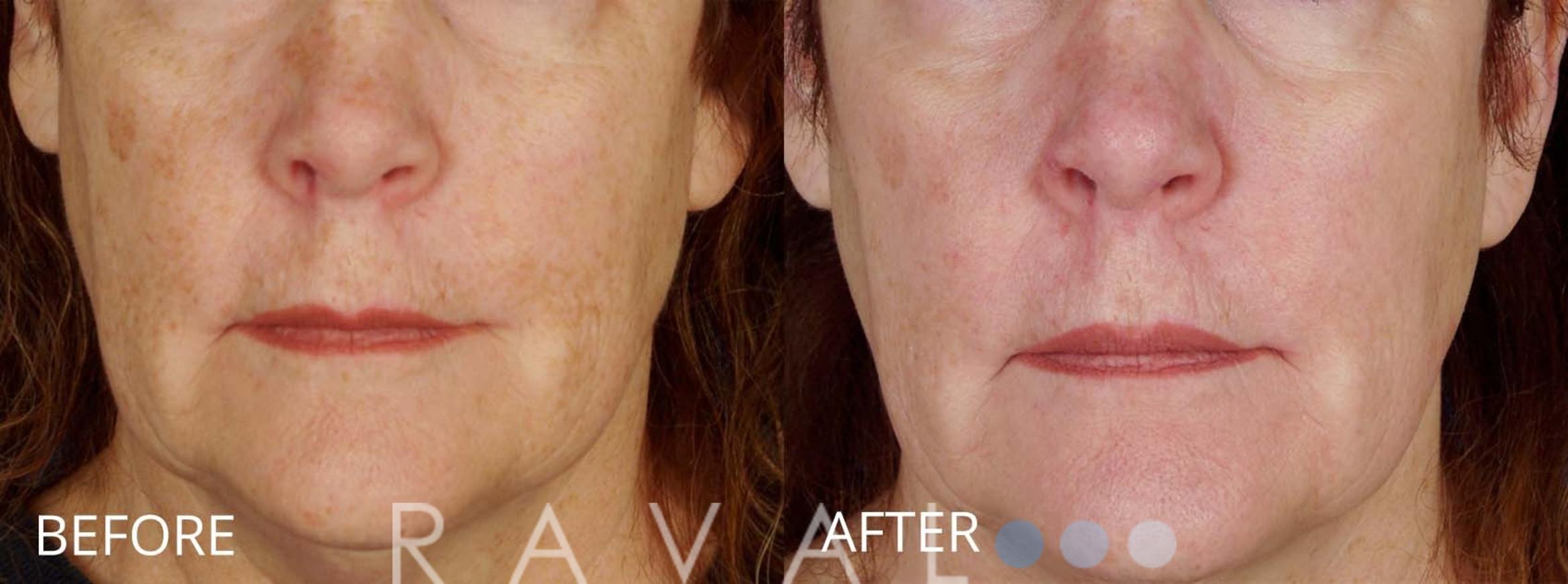 Before & After Skin Treatments Case 1111 View 1 View in Denver, CO