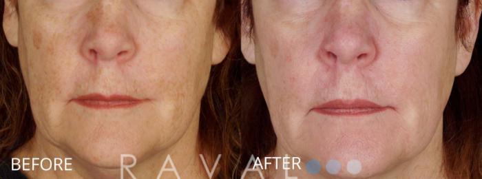 Before & After Skin Treatments Case 1111 View 1 View in Denver, CO