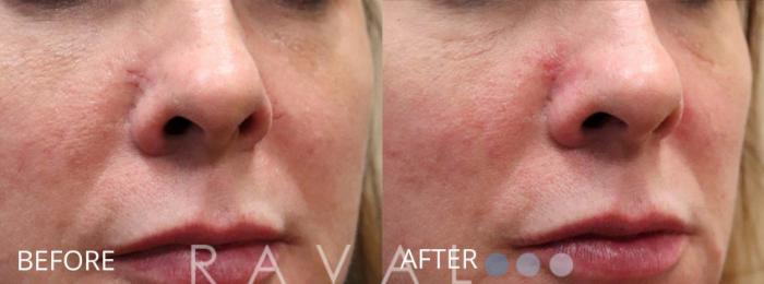 Before & After Skin Treatments Case 1112 View 1 View in Denver, CO