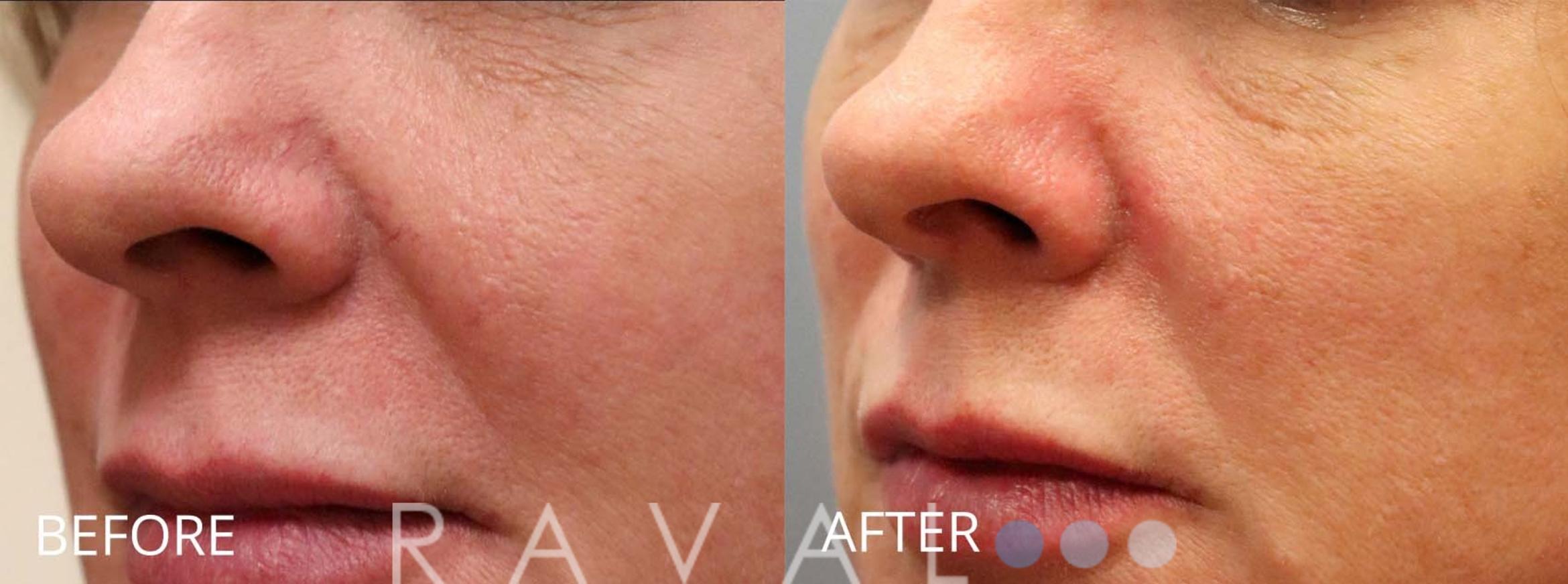 Before & After Skin Treatments Case 1112 View 2 View in Denver, CO