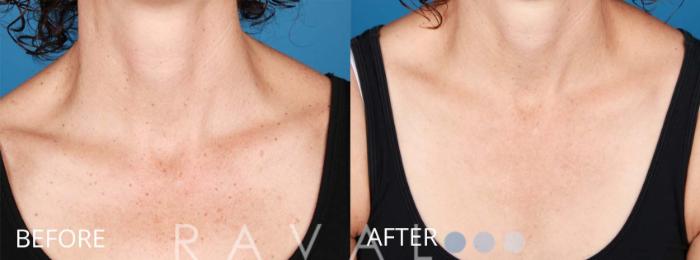Before & After Skin Treatments Case 1113 View 1 View in Denver, CO