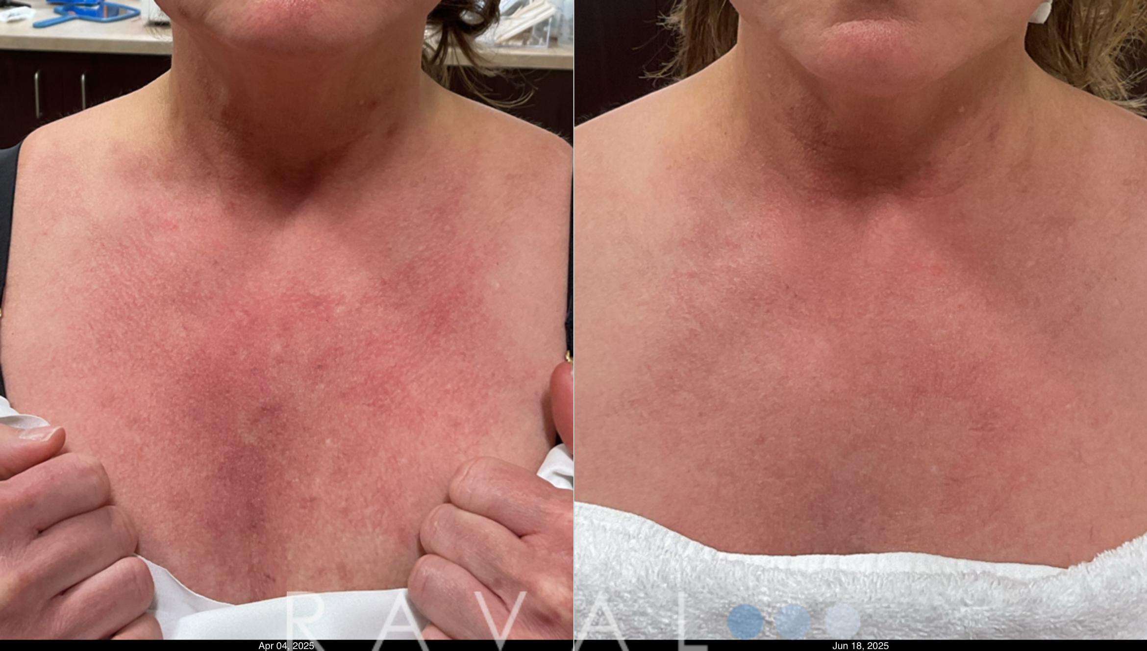 Before & After Skin Treatments Case 1114 View 1 View in Denver, CO