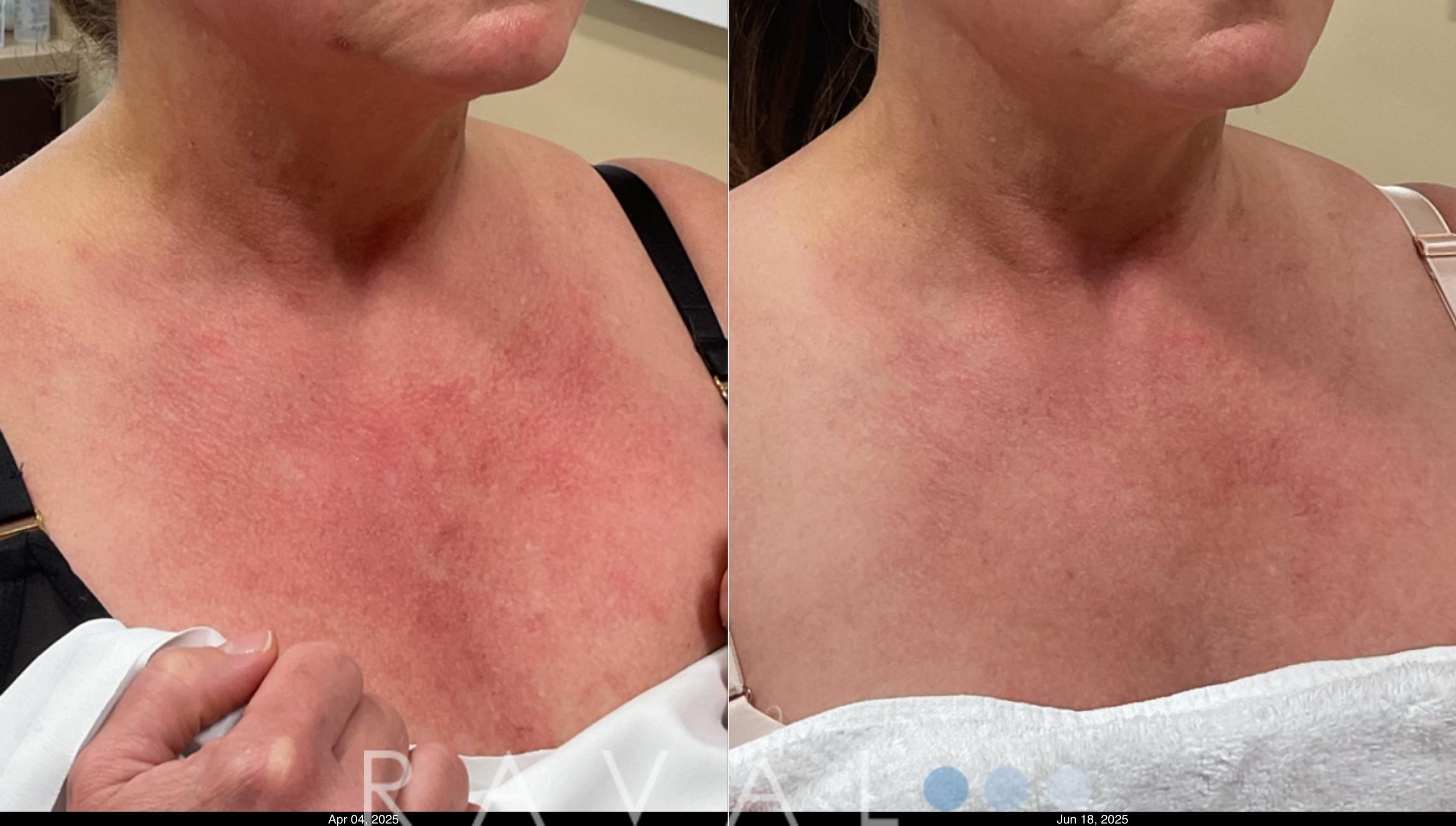 Before & After Skin Treatments Case 1114 View 2 View in Denver, CO